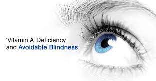 Read more about the article Vitamin A Deficiency
